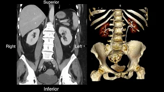 Normal Renal Anatomy