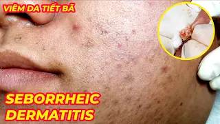 Điều trị mụn viêm nang hiệu quả tại TPHCM | Hiền Vân spa | Acne Treatment | Đỗ Thu Hiền | 659