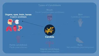 Overcoming Challenges in the Diagnosis and Treatment of Invasive Fungal Infections