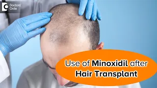 When to start minoxidil after hair transplant? - Dr. Deepak P Devakar | Doctors' Circle