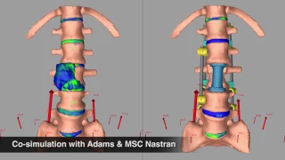 MSC Software- Spine Research Institute Customer Testimonial Using Adams and MSC Nastran