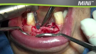 Mega'Gen MiNi implant placement - Clinical case video #1