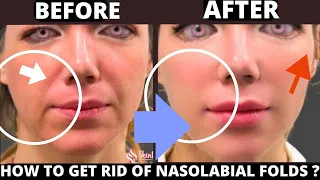 🛑 SMILE LINES FACIAL EXERCISES (NASOLABIAL FOLDS) | JOWSL | ANTI-AGING EXERCISES FOR WRINKLES