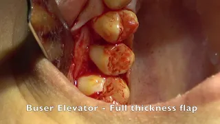 Crown lengthening of a maxillary premolar