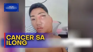 Mukha ng Balita | Lalaki, tinamaan ng rare na cancer