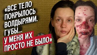 У меня язвы по всему телу: Алина | Вопреки