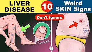 10 Skin signs of Liver Disease | Fatty liver | Cirrhosis of the Liver | Fatty liver Symptoms