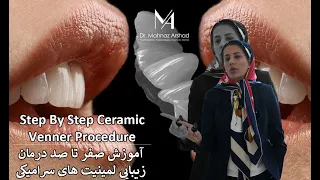 Step by Step Ceramic Veneer Procedure