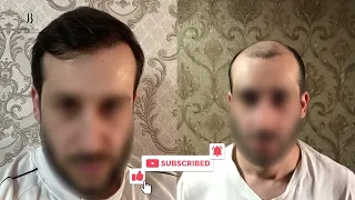 Hair transplant before and after / Bellus Clinic