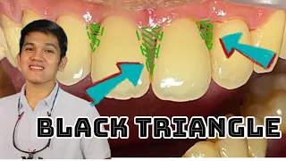 BLACK TRIANGLE Sa Gilagid, no need for braces?