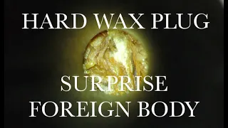 EAR WAX REMOVAL : SURPRISE FOREIGN BODY : 4K/HD