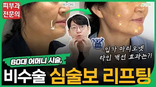 심술보, 심부볼, 마리오네트 주름 등 비수술로 없애는 방법📌 (50대,60대 리프팅 추천, 전후사진 등)