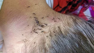 Removing all thousand lice from short hair - Pick out a lot of louse from head