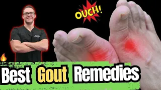 🔥What is Gout? TRUE Causes & Treatments! [Symptoms, Diet & Diagnosis]