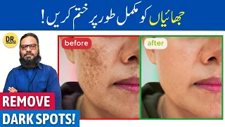 Chehre Ki Chaiyan/Jhaiya Ka Khatma | Fade Hyperpigmentation, Dark/Age Spots