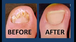 Toenail Fungus Commercial | World's Best Toenail Fungus Treament! [2018]