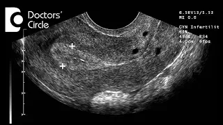 Is pregnancy possible with normal endometrial lining in follicular study? - Dr. Shefali Tyagi