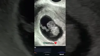 🎥УЗИ беременности