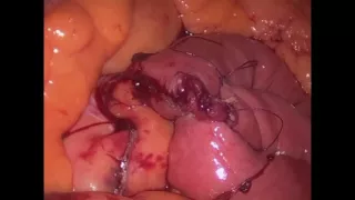 Instructional Roux En Y Gastric Bypass Video