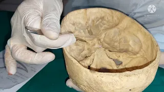 Interior of Skull : Part 3 Middle Cranial Fossa.