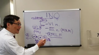 Internuclear Ophthalmoplegia (INO)