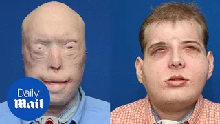 Details of the most extensive face transplant ever explained - Daily Mail