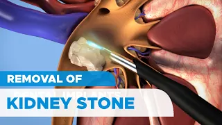 Removal of Kidney Stones: Percutaneous Nephrolithotomy (PCNL) for Kidney Stones