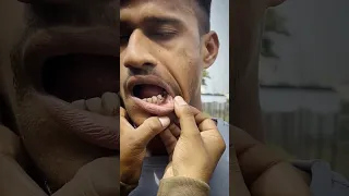 Indian Army Teeth Medical Test