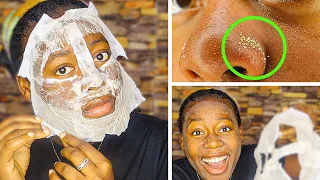 Shocking Easy DIY Blackheads And Whitehead Removal Peel Off Mask.