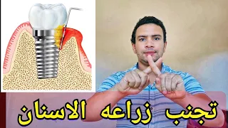 9 اسباب تجعلك تتجنب زراعه الاسنان نهائيآ