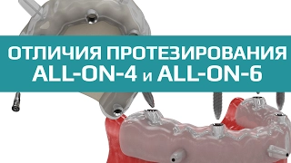 Отличия протезирования all-on-4 от all-on-6