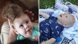 Baby Born with Brain Outside of Skull Gets Life-Changing Surgery