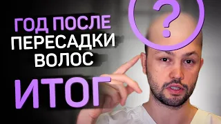 Пересадка волос. Год спустя. Полный итоговый отчет.