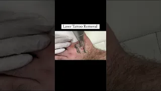 Laser Tattoo Removal | How to remove Tattoo? | Laser Treatment Real Video | Dr Anvika #shorts