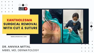 Xantholesma - Surgical Removal with Cut & Suture | Skincare | Dr. Anvika Mittal, Dermatologist