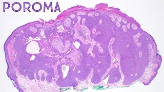 Poroma: Dermpath in 5 Minutes (dermatology pathology dermatopathology board review)