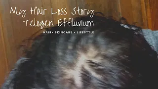 My Hair Loss Story (Nioxin & Redken)