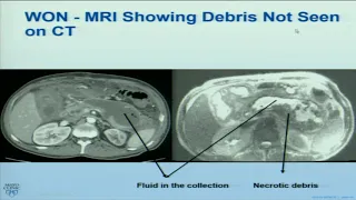 Medicine Grand Rounds: Acute Pancreatitis 3/5/19