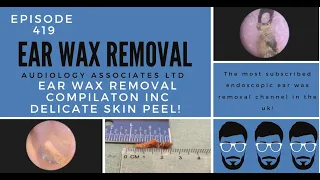 EAR WAX REMOVAL COMPILATION INC DELICATE SKIN PEEL - EP419