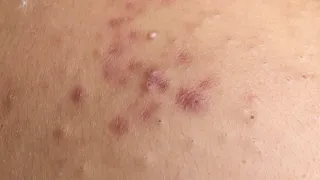 AWESOME BIG INFLAMED BLACKHEADS | Suri Job 125