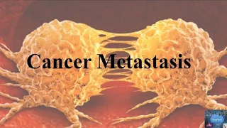 Metastasis #cancer #metastasis #metastaticbreastcancer #oncology