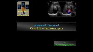 Ultrasound Case 118 - IVC Aneurysm