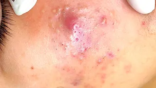 Acne Treatment vídeo 0007