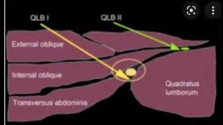 Quadratus Lumborum Block 1,2, 3 -Clinical tips.- Presentation by Dr Amit Dikshit