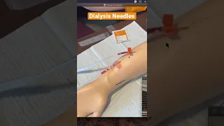 Dialysis: AV Fistula How to Insert Needles Trailer