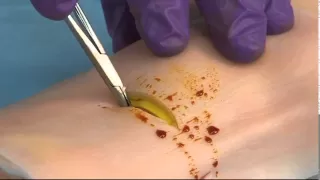 Venous Cutdown.mp4