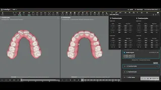 Invisalign First Before and After