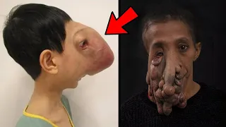 10 Bizarre People Who Suffer Very Rare Conditions