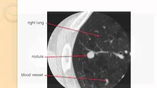 GRACEcast-087_Lung-Cancer_Detection and Work-Up of Lung Nodules, by David Yankelevitz