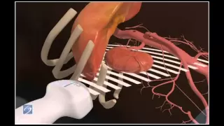 How To: Right Kidney Ultrasound 3D Video